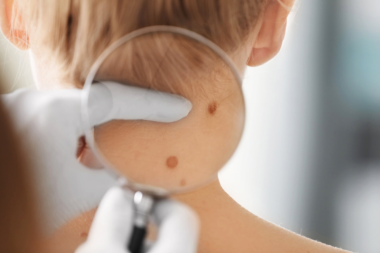 Дерматит у дітей та дорослих 1 dermatit01