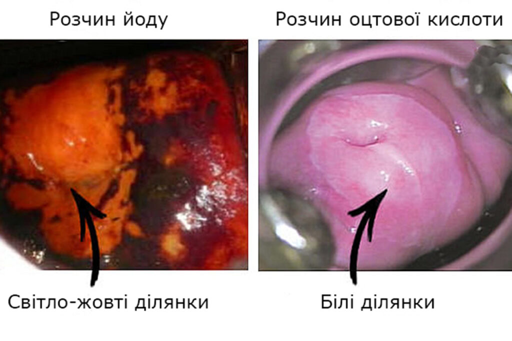 Розширена кольпоскопія кольпоскопія