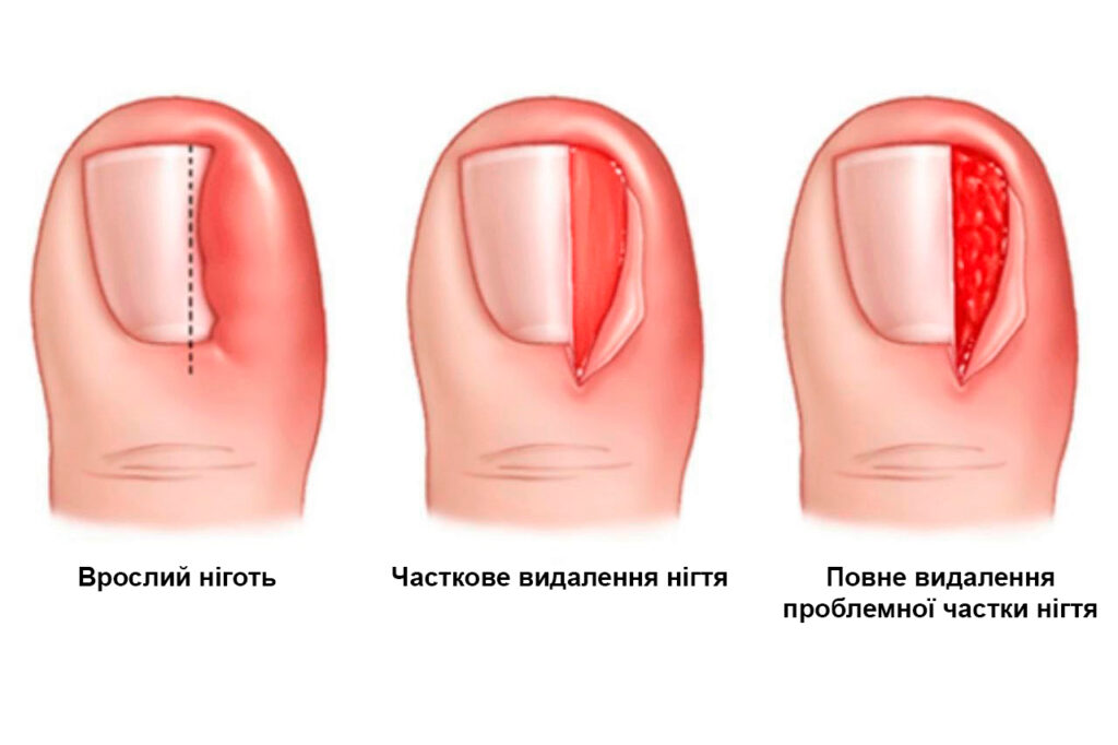 Врослий ніготь 4 врослий ніготь