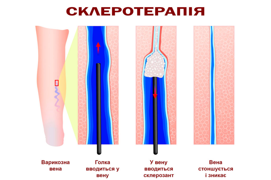 Ін'єкційна склеротерапія 4 склеротерапія