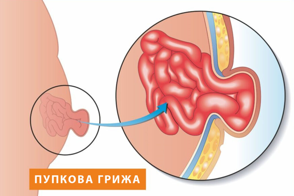 Грижа