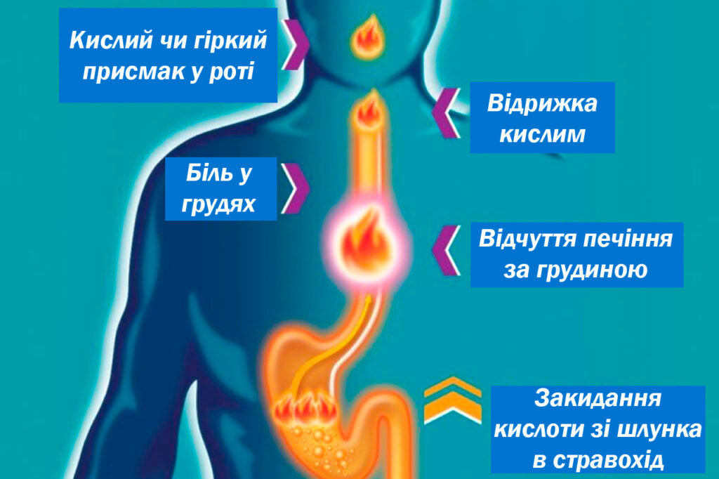 Чим небезпечна печія? 2 виникнення печії