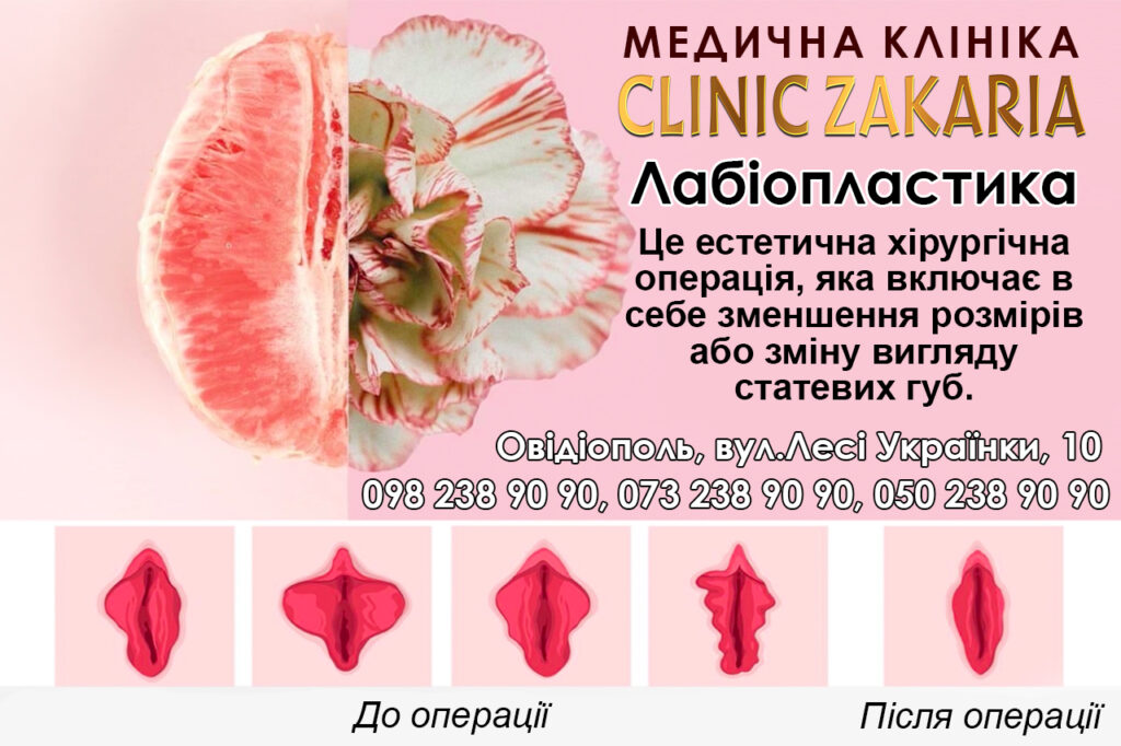 Інтимна пластика 2 лабіопластика