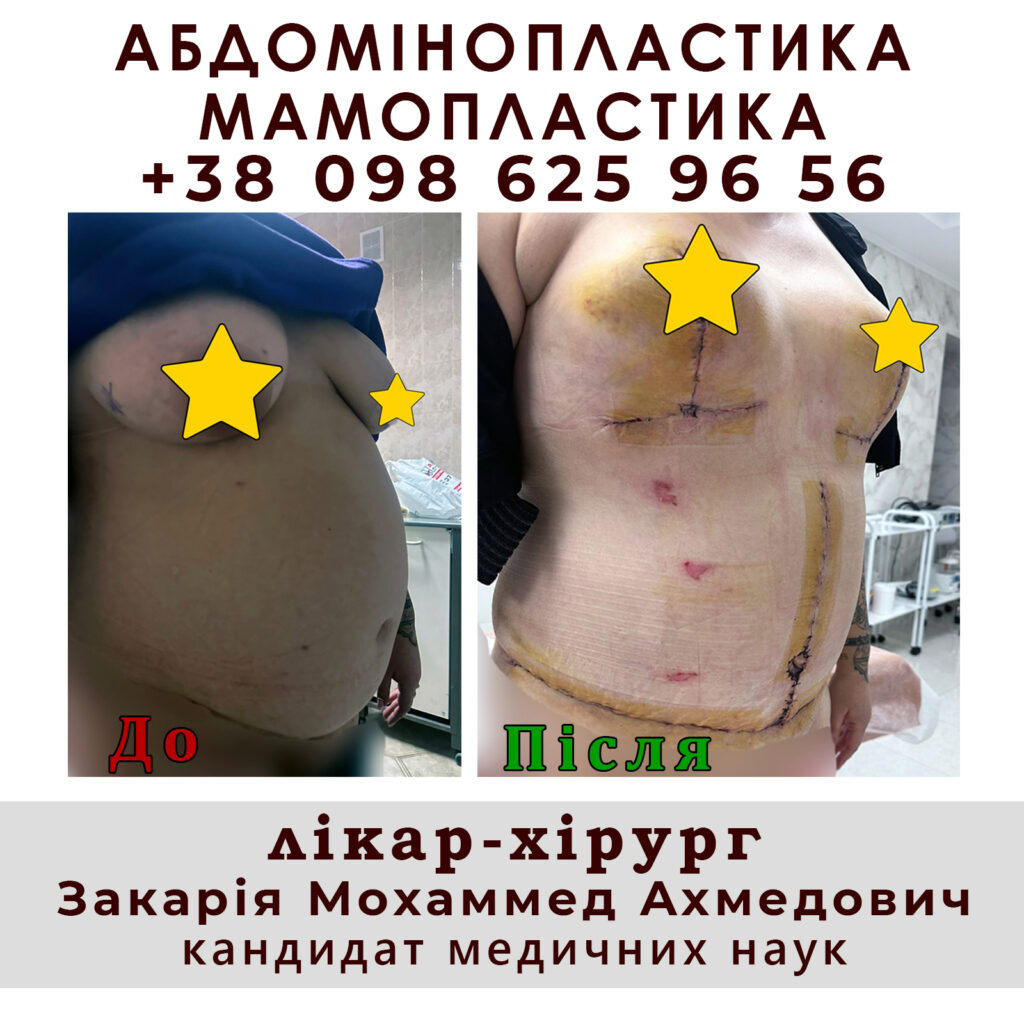 Мамопластика 6 abdominoplastika3 1