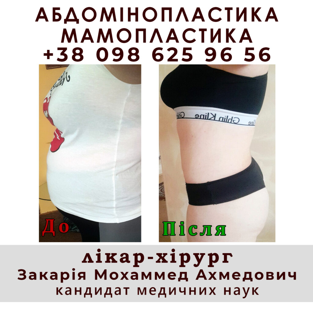 Мамопластика 7 abdominoplastika4