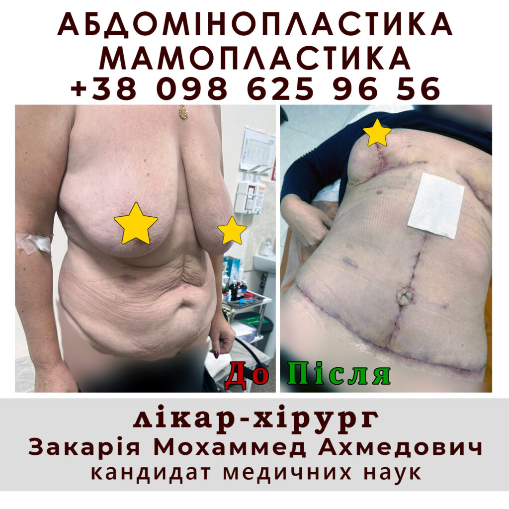 Мамопластика 8 abdominoplastika5
