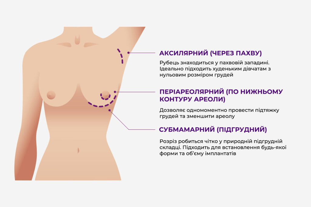 Мамопластика 5 Мамопластика