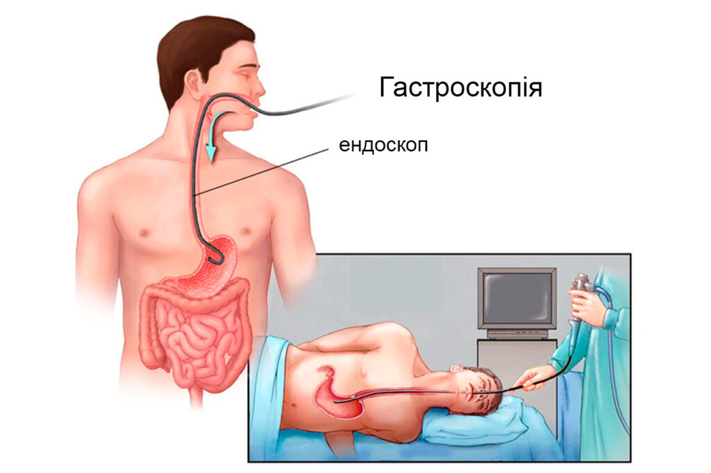 Гастроскопія 4 гастроскопія